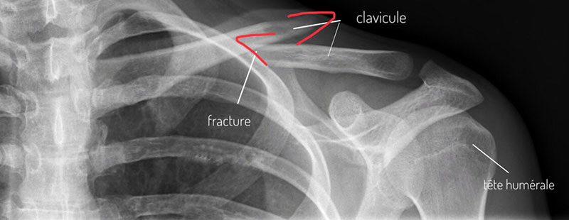 clavicule-fracture