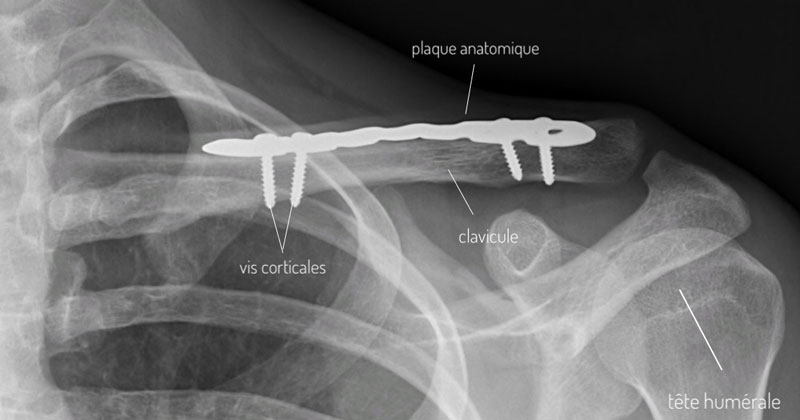 clavicule-oestheosynthese