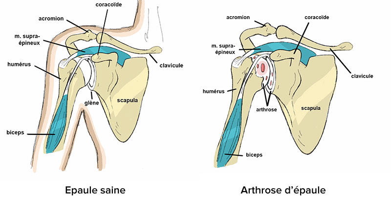 epaule-arthrose