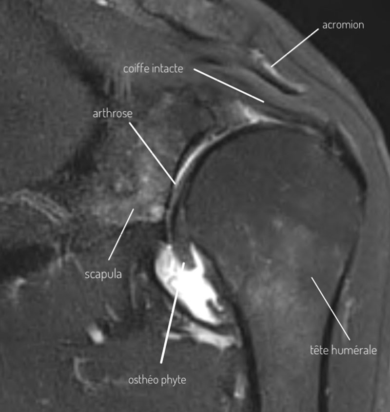 irm-arthrose-epaule