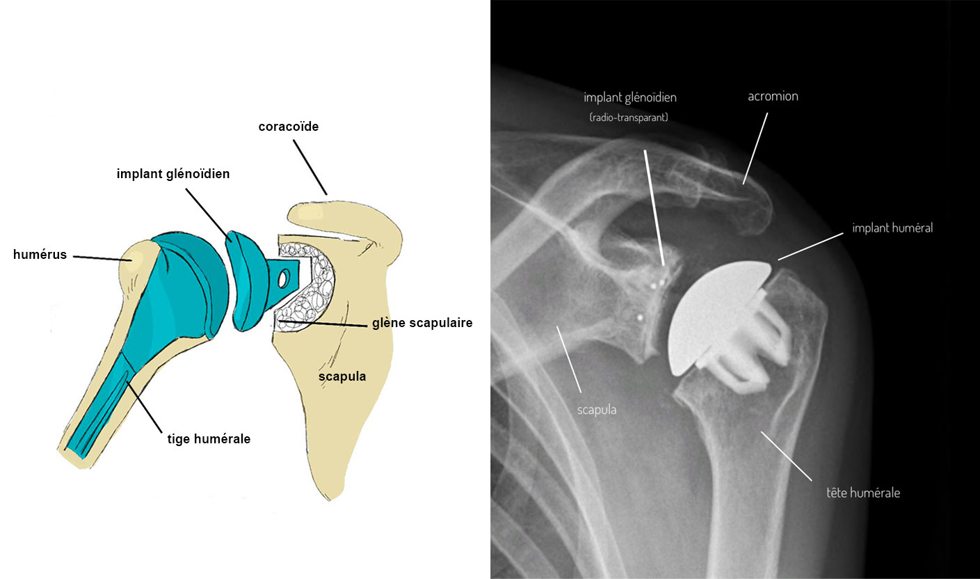 prothese-anatomique-epaule