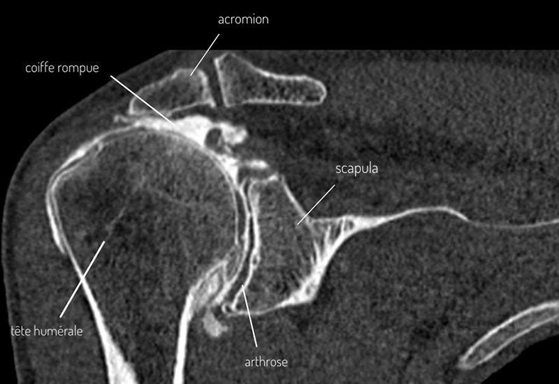 scanner-arthrose-epaule